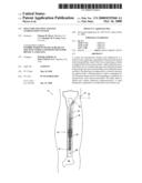 Fracture Fixation and Site Stabilization System diagram and image