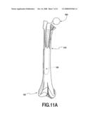 Fracture Fixation and Site Stabilization System diagram and image