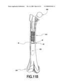 Fracture Fixation and Site Stabilization System diagram and image