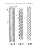 Fracture Fixation and Site Stabilization System diagram and image