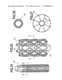 Fracture Fixation and Site Stabilization System diagram and image