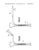 Fracture Fixation and Site Stabilization System diagram and image