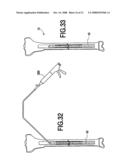 Fracture Fixation and Site Stabilization System diagram and image