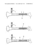 Fracture Fixation and Site Stabilization System diagram and image