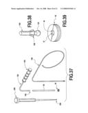 Fracture Fixation and Site Stabilization System diagram and image