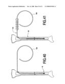 Fracture Fixation and Site Stabilization System diagram and image