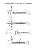 Fracture Fixation and Site Stabilization System diagram and image