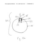 Apparatus and method for remote deflation of intragastric balloon diagram and image