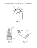 Implant Device Particularly Useful For Implantation In the Intravascular System For Diverting Emboli diagram and image