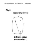 LABELED VASCULAR PATCH diagram and image