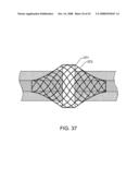 Implantable Addressable Segmented Electrodes diagram and image