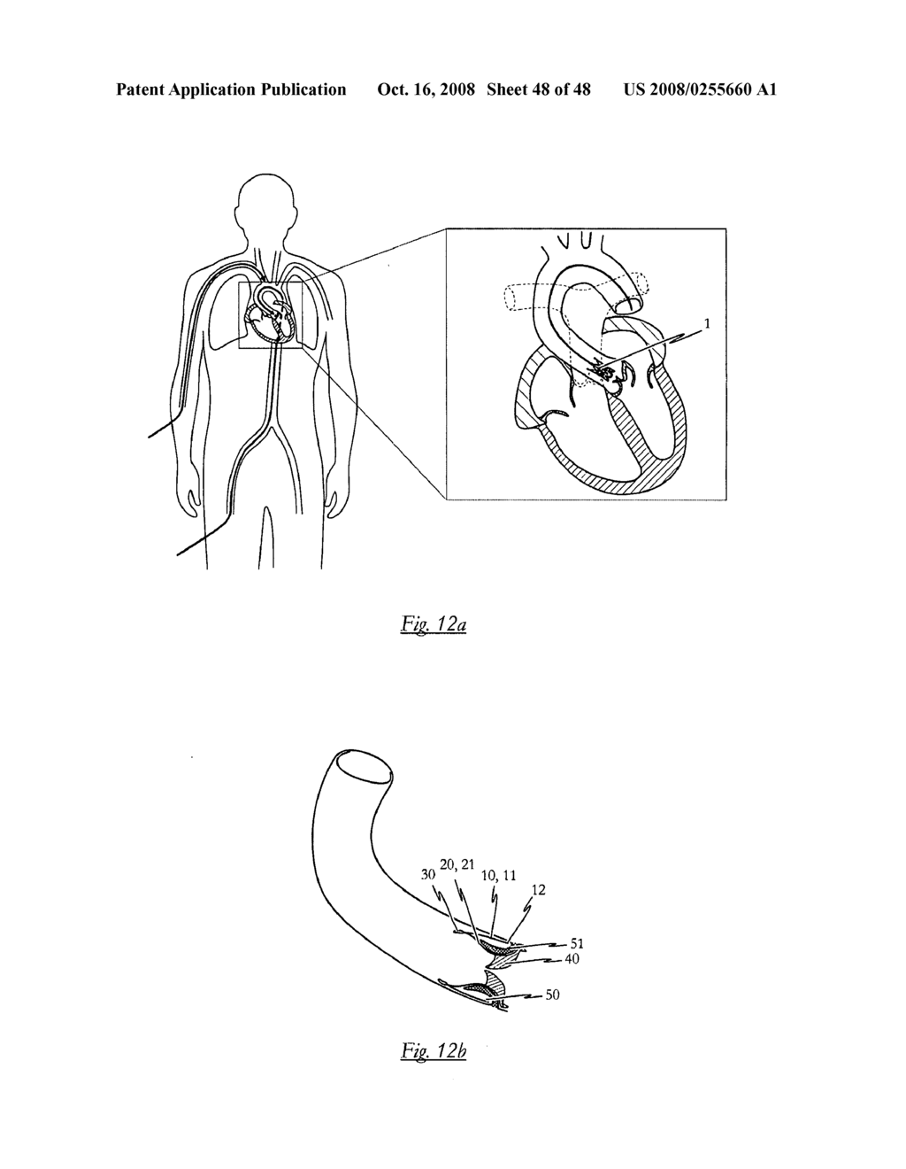 Medical device for treating a heart valve insufficiency - diagram, schematic, and image 49