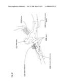 Active blood vessel sleeve methods and systems diagram and image