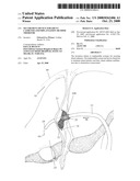 SECUREMENT DEVICE FOR SHUNT CATHETER AND IMPLANTATION METHOD THEREFOR diagram and image