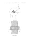 SECUREMENT DEVICE FOR SHUNT CATHETER AND IMPLANTATION METHOD THEREFOR diagram and image