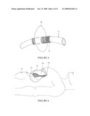 SECUREMENT DEVICE FOR SHUNT CATHETER AND IMPLANTATION METHOD THEREFOR diagram and image