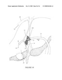 SECUREMENT DEVICE FOR SHUNT CATHETER AND IMPLANTATION METHOD THEREFOR diagram and image