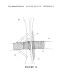 SECUREMENT DEVICE FOR SHUNT CATHETER AND IMPLANTATION METHOD THEREFOR diagram and image