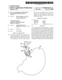 DEVICE AND METHOD FOR TREATMENT OF GASTROESOPHAGEAL REFLUX DISEASE diagram and image