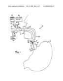 DEVICE AND METHOD FOR TREATMENT OF GASTROESOPHAGEAL REFLUX DISEASE diagram and image