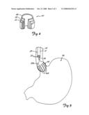 DEVICE AND METHOD FOR TREATMENT OF GASTROESOPHAGEAL REFLUX DISEASE diagram and image