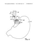 DEVICE AND METHOD FOR TREATMENT OF GASTROESOPHAGEAL REFLUX DISEASE diagram and image