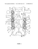 CROSS-COUPLED VERTEBRAL STABILIZERS INCORPORATING SPINAL MOTION RESTRICTION diagram and image