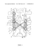 CROSS-COUPLED VERTEBRAL STABILIZERS INCORPORATING SPINAL MOTION RESTRICTION diagram and image