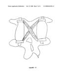 CROSS-COUPLED VERTEBRAL STABILIZERS INCORPORATING SPINAL MOTION RESTRICTION diagram and image