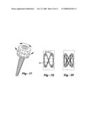 CROSS-COUPLED VERTEBRAL STABILIZERS INCORPORATING SPINAL MOTION RESTRICTION diagram and image