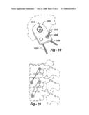 CROSS-COUPLED VERTEBRAL STABILIZERS INCORPORATING SPINAL MOTION RESTRICTION diagram and image