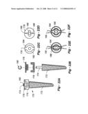 CROSS-COUPLED VERTEBRAL STABILIZERS INCORPORATING SPINAL MOTION RESTRICTION diagram and image