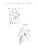 SEGMENTED RING PLACEMENT diagram and image