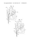 SEGMENTED RING PLACEMENT diagram and image