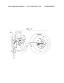 SEGMENTED RING PLACEMENT diagram and image