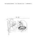 SEGMENTED RING PLACEMENT diagram and image