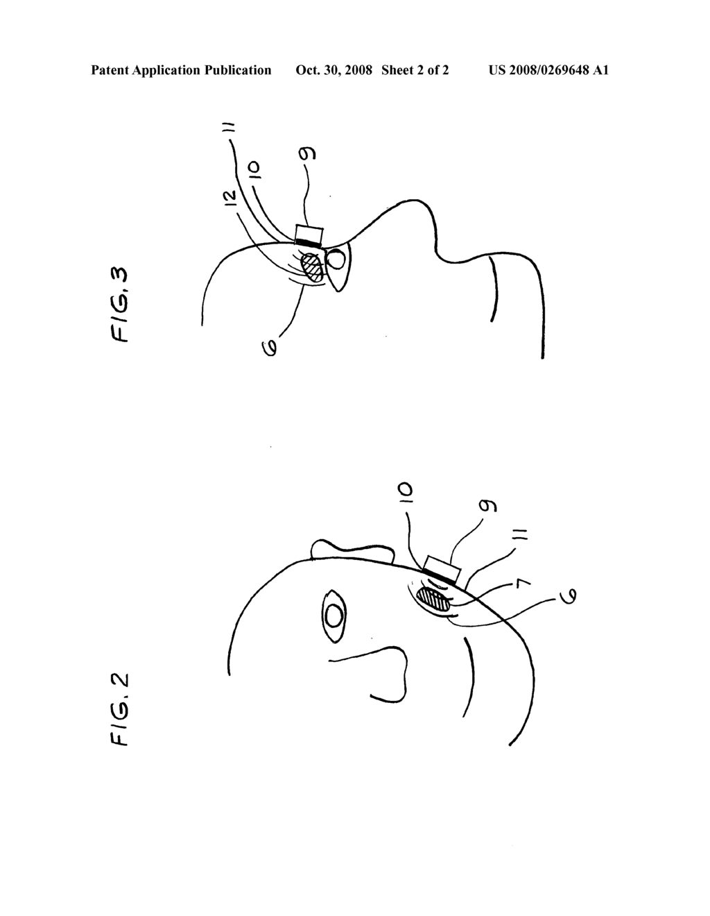 Method for increasing saliva and tear production with ultrasound - diagram, schematic, and image 03