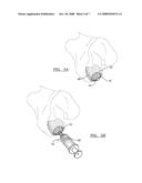 Localized Cartilage Defect Therapy diagram and image