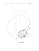 Localized Cartilage Defect Therapy diagram and image