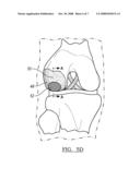 Localized Cartilage Defect Therapy diagram and image