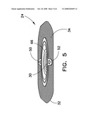 Ostomy pouch diagram and image