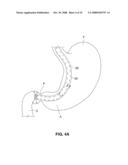 SATIATION DEVICES AND METHODS diagram and image