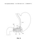 SATIATION DEVICES AND METHODS diagram and image