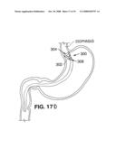 SATIATION DEVICES AND METHODS diagram and image