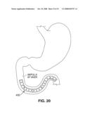 SATIATION DEVICES AND METHODS diagram and image