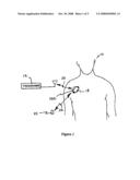 Implantable medical device for treating neurological conditions with an initially disabled cardiac therapy port and leadless ECG sensing diagram and image