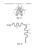 IMPLANTABLE MEDICAL LEADS WITH FLEXIBILITY AND EXTENSIBILITY, AND HAVING A SUBSTANTIALLY TWO-DIMENSIONAL NATURE diagram and image