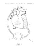 Implantable heart assist system and method of applying same diagram and image