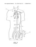 Implantable heart assist system and method of applying same diagram and image