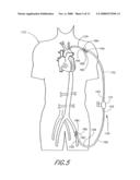 Implantable heart assist system and method of applying same diagram and image